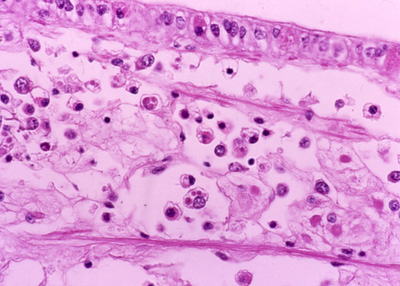 infection with Bonamia exitiosus