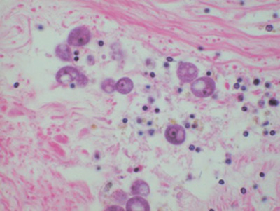 infection with Perkinsus olseni