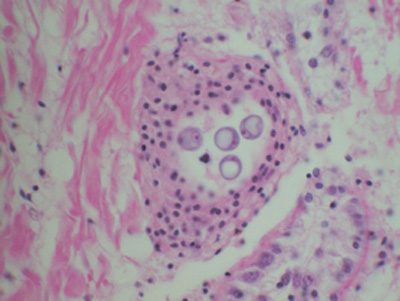 infection with Perkinsus olseni