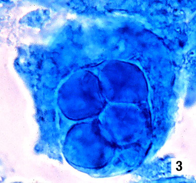  Spherical Baculovirosis